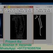 Bone Fracture Detection Using Image Processing
