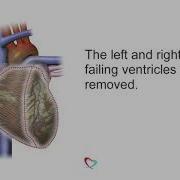 SynCardia Total Artificial Heart Surgical Progression Animation