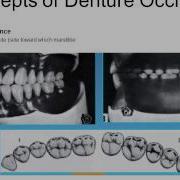 Complete Denture Occlusion