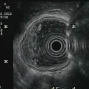 REFLECTION MIRROR IMAGE ARTIFACT DURING EUS CHRISTOS KARALIS MD