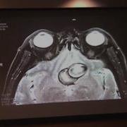 A Case Of Optic Neuropathy The Importance Of Visual Field Testing ARCHIVE