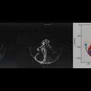 Vortex Ring Interaction With Concave Cavity