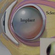 Ocular Implant And Prosthesis After Evisceration