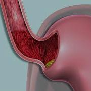 Gastroesophageal Reflux GERD