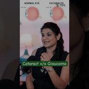 Cataract Vs Glaucoma What S The Difference Cataract Glaucoma Shorts Netrameyefoundation