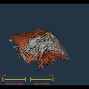 VTK Shoulder Reconstruction