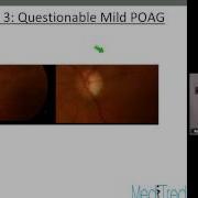 Glaucoma Lecture Series 3 Primary Open Angle Glaucoma