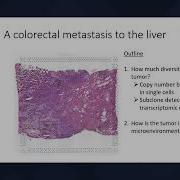 Keynote Nancy Zhang Tumor Subclone Detection And Immune Niche Modeling On Spatial Transcriptomics