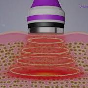 How Ultrasonic Cavitation Work How Ultrasonic Cavitation Remove Fat What Is Cavitation Machine