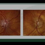 The Pressure Is On Managing Challenging Cases In Glaucoma 11 9 2021