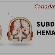 Subdural Hematoma Symptoms CT Findings Treatment Neurotrauma Explained CanadaQBank
