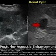 Why Does Posterior Acoustic Enhancement Appear Bright Ultrasound Artifacts Fluid Filled Spaces