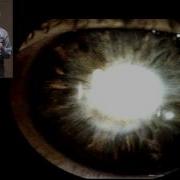 Pathology Glaucoma ARCHIVE
