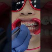 Watch How Metal Braces Are Put On