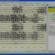 Persyst Routine Ambulatory Quick Start Video