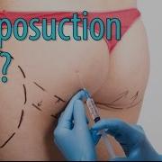 Is Liposuction Under Local Anesthesia Safe