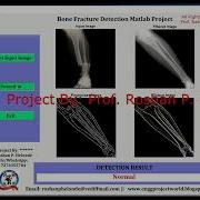 Bone Fracture Detection Using Deep Learning With Source Code Bone Fracture Detection Using Matlab