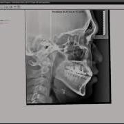 14 An Introduction To Superimposition Tutorial Video For OrthoVision