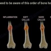 How Does Broken Bone Heal