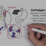 Upper GI Bleed Causes Overview