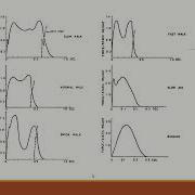 Vibration Analysis Of Foot Bridge
