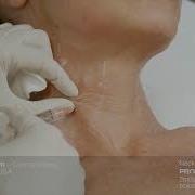 Profhilo Neck פרופילו