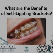 What Are The Benefits Of Self Ligating Brackets