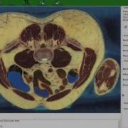 Using VTK In The Reconstruction Of The Human Body