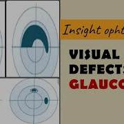 FIELD DEFECTS IN GLAUCOMA Arcuate Paracentral Nasal Step Temporal Wedge Baring Of Blindspot