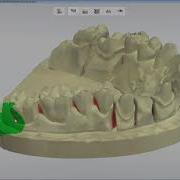 3DBioCAD 3Shape Dental System Adaptive Scanning