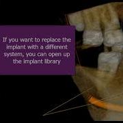 Using CS 3D Imaging Software For Implant Planning