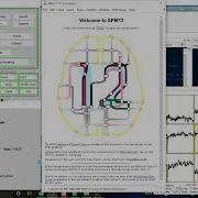 Realignment And Framewise Displacement SPM MATLAB Resting State FMRI Data AFNI