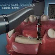 Dental Implants Surgical Kit By MIS