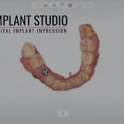 Оттиск имплантата 3Shape Trios