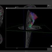 BrainMagix 2 1 Constrained Spherical Deconvolution CSD Based Tractography