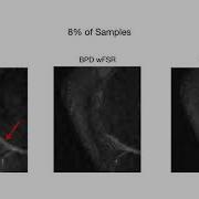 Utilizing The Wavelet Transform S Structure With Compressed Sensing