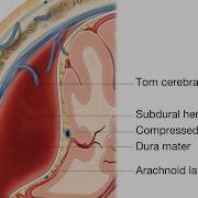Subdural Hematoma
