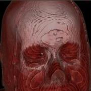 Vtk Ct Head Volume 1
