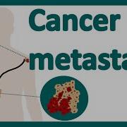 Cancer Metastasis Cancer Metastasis Mechanism Metastasis How Do Cancers Spread In The Body