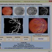 Matlab Code For Diabetic Retinopathy Detection Using Image Processing