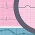 Норма ЭКГ Все интервалы и зубцы P QRS T PR ST