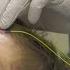 EEG Testing And Monitoring What To Expect